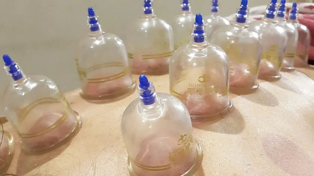 Ventosas aplicadas en la espalda
